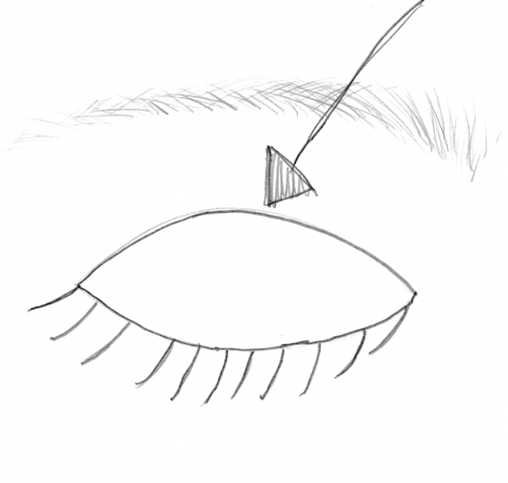 Tegning av et øyelokk.